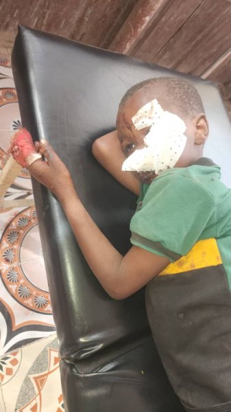 Children wounded in Turkish drone strike in Baqdaad village, Somalia on Monday, March 18, 2024. | Photo Kaab TV. Children wounded in Turkish drone strike in Baqdaad village, Somalia on Monday, March 18, 2024. | Photo Kaab TV.